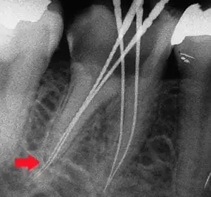 顯微鏡輔助根管治療 顯微鏡輔助根管治療