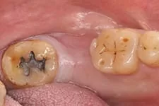 微創植牙 微創植牙