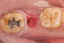 微創植牙 微創植牙