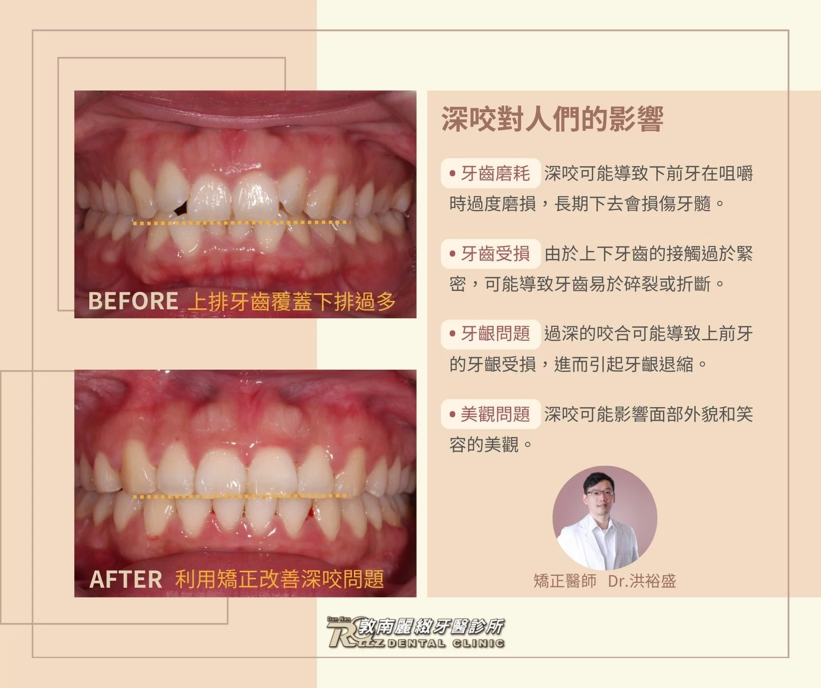 深咬可能會造成嚴重的牙齒磨耗、與牙周問題 深咬可能會造成嚴重的牙齒磨耗、與牙周問題