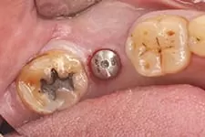 微創植牙 微創植牙