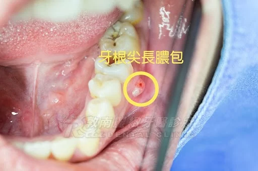 解析根管治療及其治療階段 解析根管治療及其治療階段