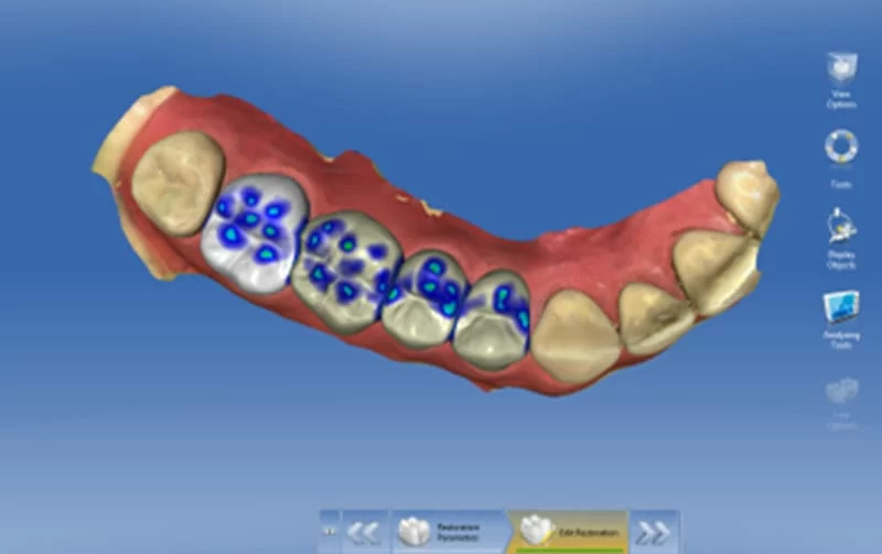 人工智慧3D軟體設計與補綴體研磨前預覽