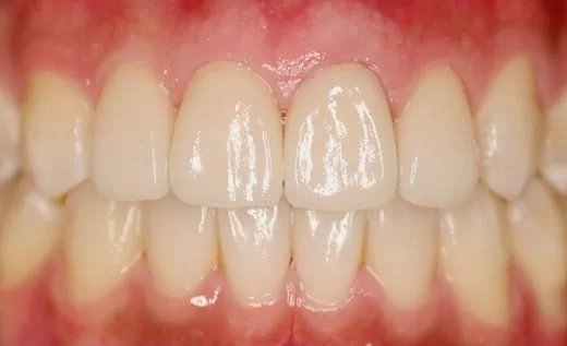 3D齒雕全瓷牙套，恢復牙齒的美觀