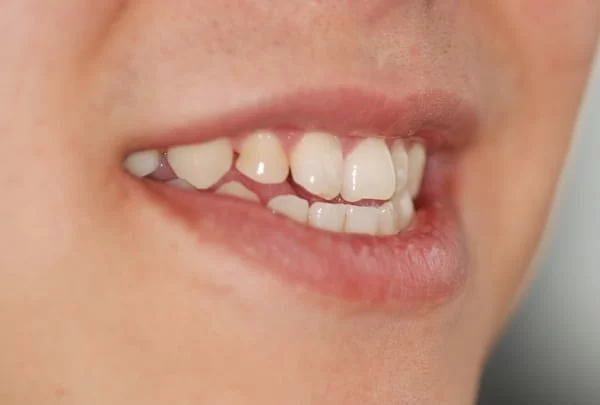 前牙大牙縫，3D齒雕恢復自信與光采