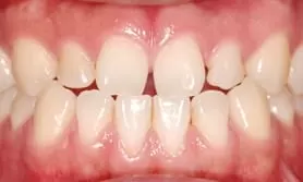 前牙大牙縫，3D齒雕恢復自信與光采