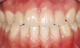 前牙大牙縫，3D齒雕恢復自信與光采