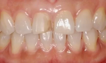 門牙修復開口不尷尬，還原自然齒色及笑容