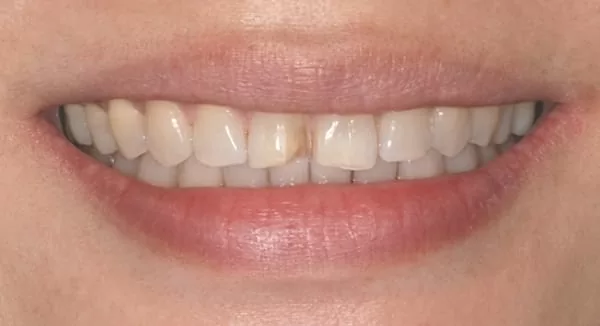 門牙修復開口不尷尬，還原自然齒色及笑容