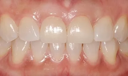 門牙修復開口不尷尬，還原自然齒色及笑容