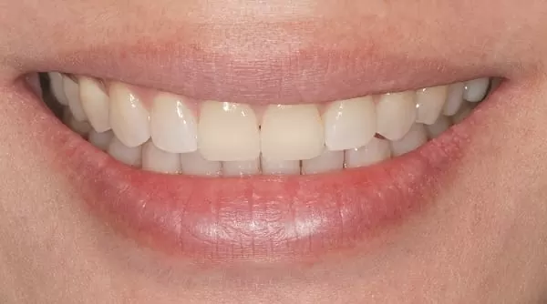 門牙修復開口不尷尬，還原自然齒色及笑容