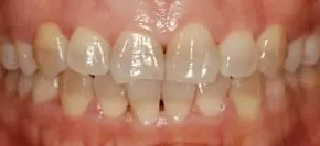 告別黃板牙全口美白瓷貼片，恢復牙齒功能及美觀