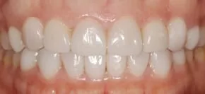 告別黃板牙全口美白瓷貼片，恢復牙齒功能及美觀