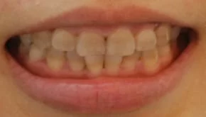 告別黃板牙全口美白瓷貼片，恢復牙齒功能及美觀