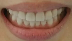 告別黃板牙全口美白瓷貼片，恢復牙齒功能及美觀