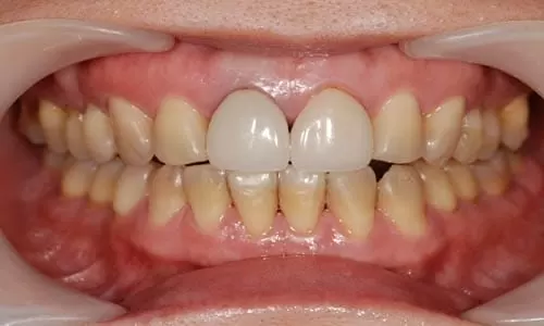 四環黴素造成黃板牙，3D齒雕重建自信笑容