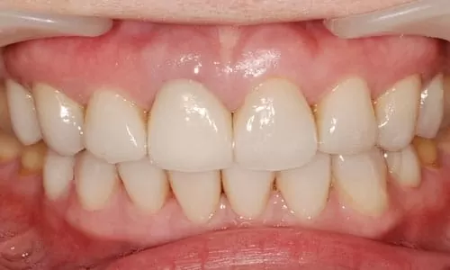 四環黴素造成黃板牙，3D齒雕重建自信笑容