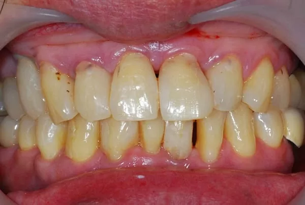 開口大門縫,要怎麼救? 開口大門縫,要怎麼救?