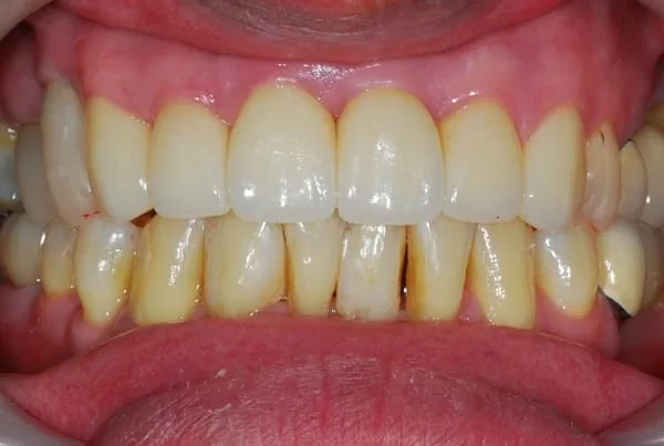 開口大門縫,要怎麼救? 開口大門縫,要怎麼救?