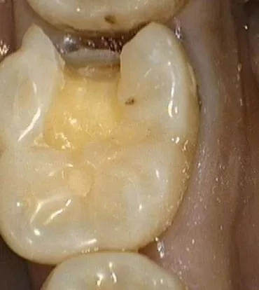 3D 齒雕補綴,仿如真牙一般,又美又耐用 3D 齒雕補綴,仿如真牙一般,又美又耐用