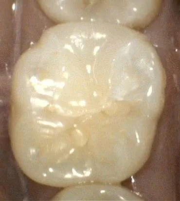 3D 齒雕補綴,仿如真牙一般,又美又耐用 3D 齒雕補綴,仿如真牙一般,又美又耐用