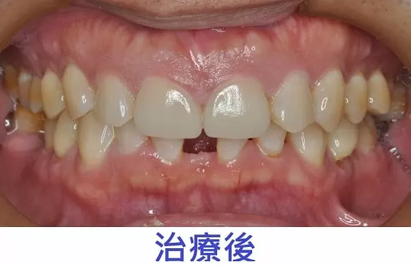 門牙縫開開一定要做矯正? 3D齒雕當日幫您解決問題