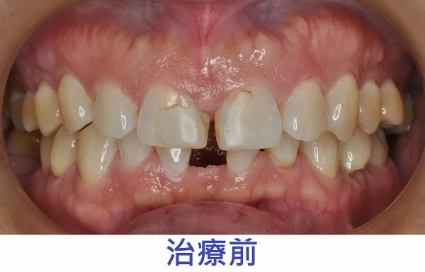 門牙縫開開一定要做矯正? 3D齒雕當日幫您解決問題