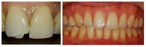 前牙、門牙的救星，超自然全瓷美容貼片
