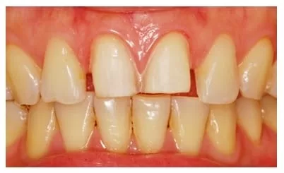 前牙、門牙的救星，超自然全瓷美容貼片