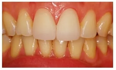 前牙、門牙的救星，超自然全瓷美容貼片