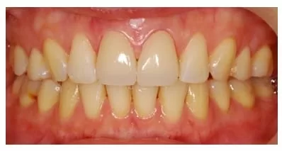 前牙、門牙的救星，超自然全瓷美容貼片