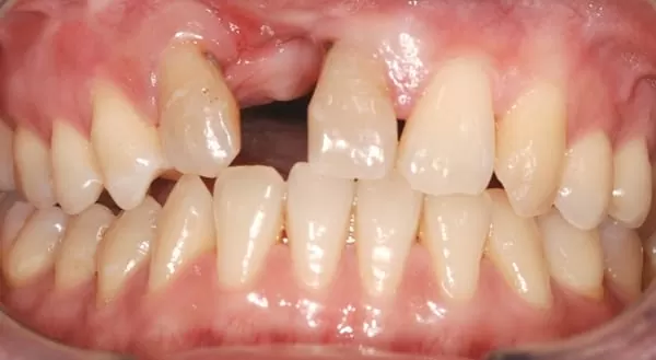 前牙美學治療- 全瓷牙冠合併人工牙齦 前牙美學治療- 全瓷牙冠合併人工牙齦