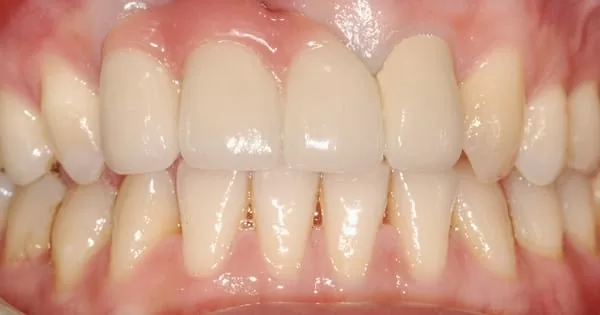 前牙美學治療- 全瓷牙冠合併人工牙齦 前牙美學治療- 全瓷牙冠合併人工牙齦