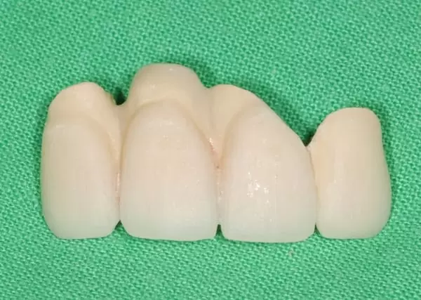 前牙美學治療- 全瓷牙冠合併人工牙齦 前牙美學治療- 全瓷牙冠合併人工牙齦