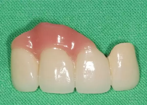 前牙美學治療- 全瓷牙冠合併人工牙齦 前牙美學治療- 全瓷牙冠合併人工牙齦