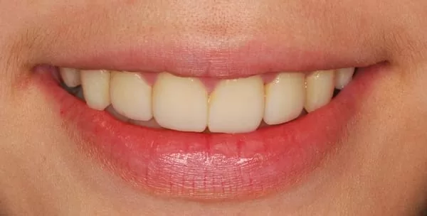 矯正後清潔保健不佳,重新進行牙齒美容 矯正後清潔保健不佳,重新進行牙齒美容