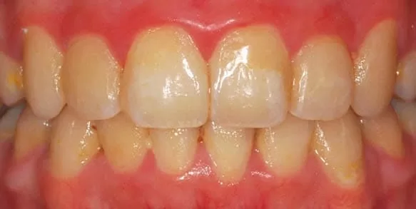 矯正後清潔保健不佳,重新進行牙齒美容 矯正後清潔保健不佳,重新進行牙齒美容