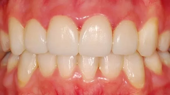 矯正後清潔保健不佳,重新進行牙齒美容 矯正後清潔保健不佳,重新進行牙齒美容