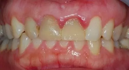 全瓷牙齒美容-讓我再次開懷大笑 全瓷牙齒美容-讓我再次開懷大笑