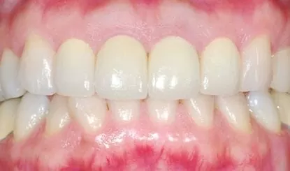 全瓷牙齒美容-讓我再次開懷大笑 全瓷牙齒美容-讓我再次開懷大笑