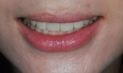 全瓷牙齒美容-讓我再次開懷大笑 全瓷牙齒美容-讓我再次開懷大笑