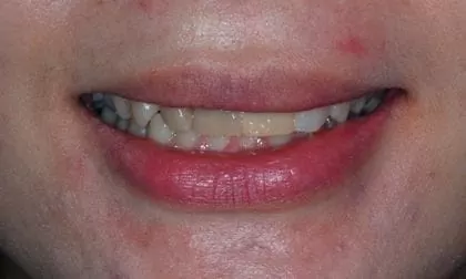 全瓷牙齒美容-讓我再次開懷大笑 全瓷牙齒美容-讓我再次開懷大笑