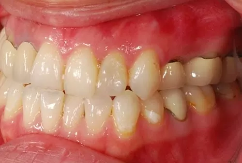 前牙假牙露出黑邊,使用全瓷牙齒進行美容修補 前牙假牙露出黑邊,使用全瓷牙齒進行美容修補