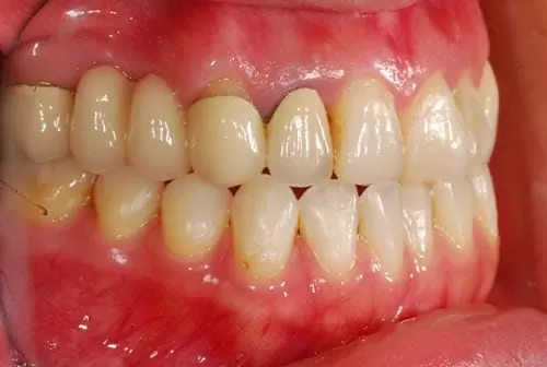 前牙假牙露出黑邊,使用全瓷牙齒進行美容修補 前牙假牙露出黑邊,使用全瓷牙齒進行美容修補