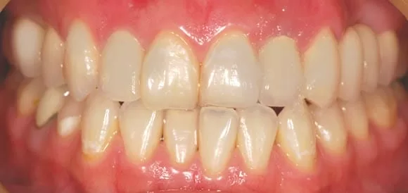 前牙假牙露出黑邊,使用全瓷牙齒進行美容修補 前牙假牙露出黑邊,使用全瓷牙齒進行美容修補