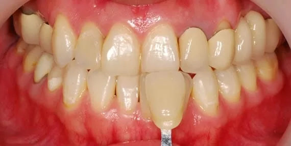 前牙假牙露出黑邊,使用全瓷牙齒進行美容修補 前牙假牙露出黑邊,使用全瓷牙齒進行美容修補