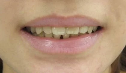 全瓷牙齒美容讓我 擁有潔白的牙齒、迷人的笑容