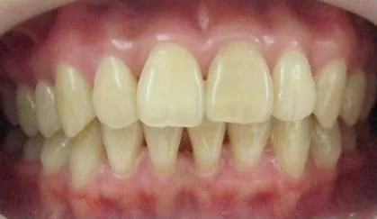 全瓷牙齒美容讓我 擁有潔白的牙齒、迷人的笑容