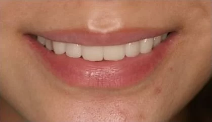 全瓷牙齒美容讓我 擁有潔白的牙齒、迷人的笑容