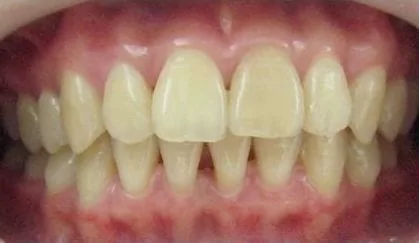 全瓷牙齒美容讓我 擁有潔白的牙齒、迷人的笑容